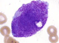Fig 1C BMA atypical promyelocyte 2